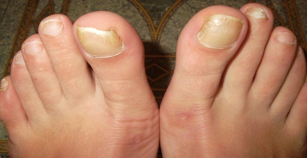 Le prime fasi del fungo dell'unghia del piede