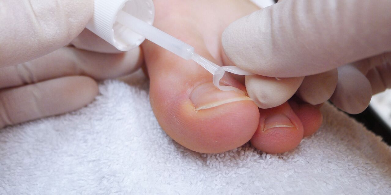 vernice medica contro i funghi delle unghie