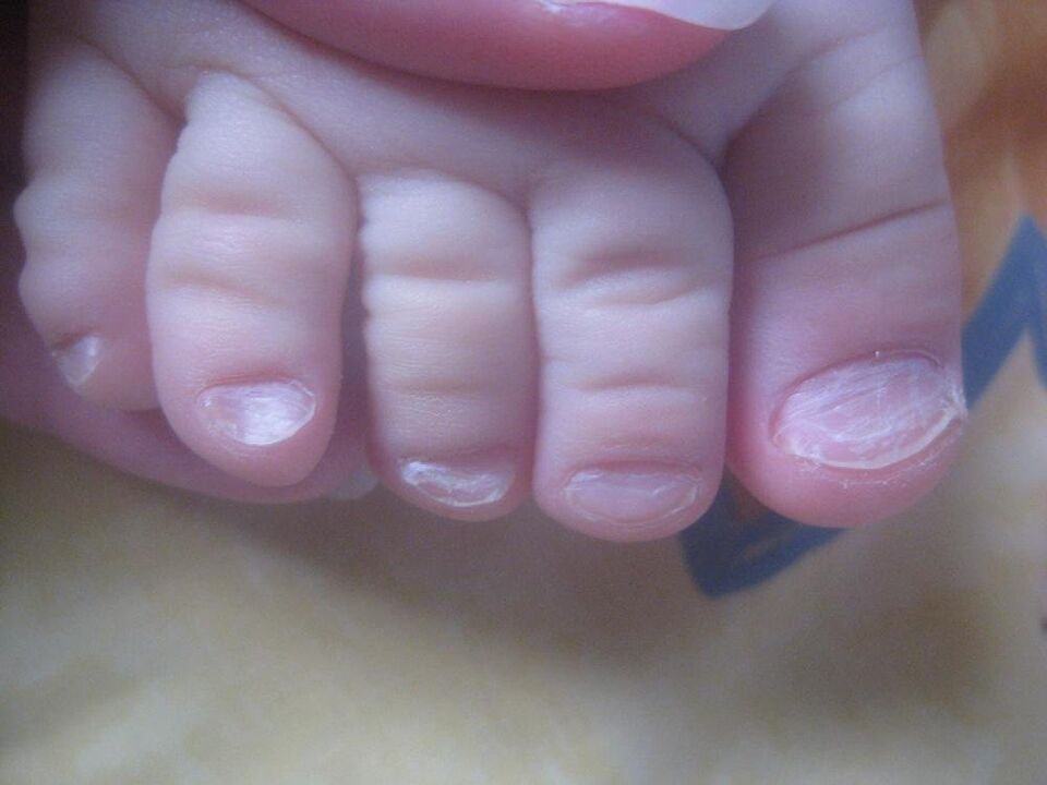 Funghi sulle unghie dei piedi nei bambini