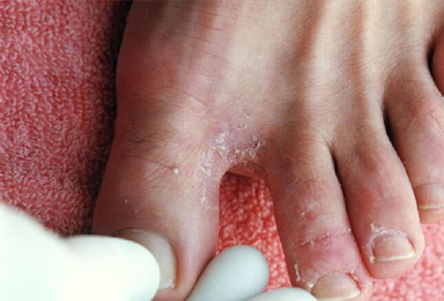 Manifestazioni di un fungo intertriginoso tra le dita dei piedi