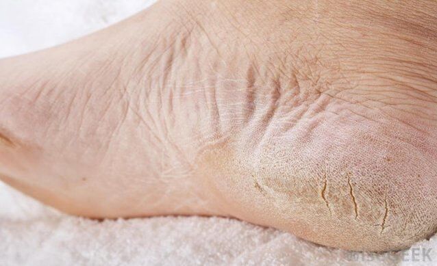 I piedi secchi sono un segno di infezione fungina
