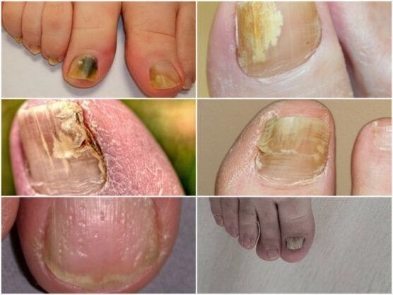 Sintomi di un'infezione fungina delle unghie
