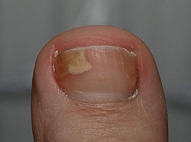 Fungo sul lato sinistro dell'unghia