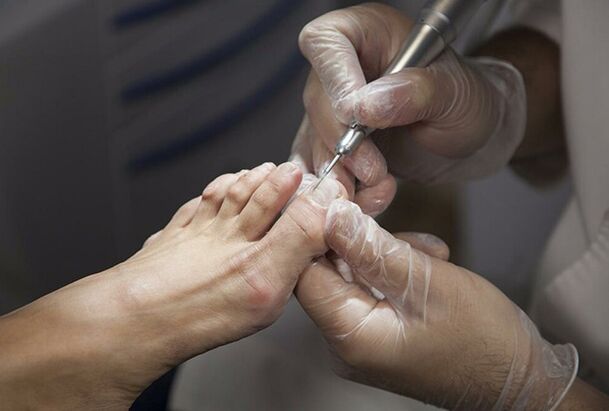 Diagnosi dei funghi delle gambe