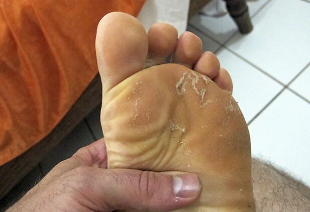 Fungo sulla pelle delle gambe