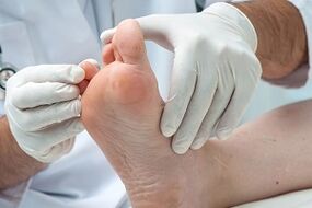 Il medico esamina i piedi per le infezioni fungine sulle dita dei piedi
