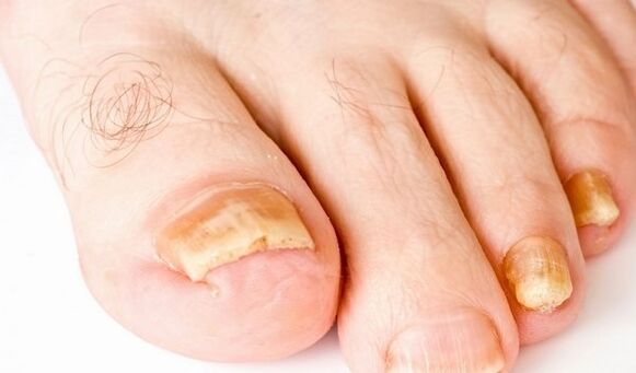 Foto dei sintomi del fungo dell'unghia del piede