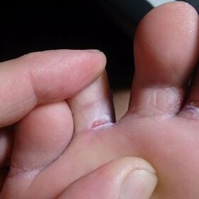 Lacerazione tra le dita dei piedi Sintomi fungini